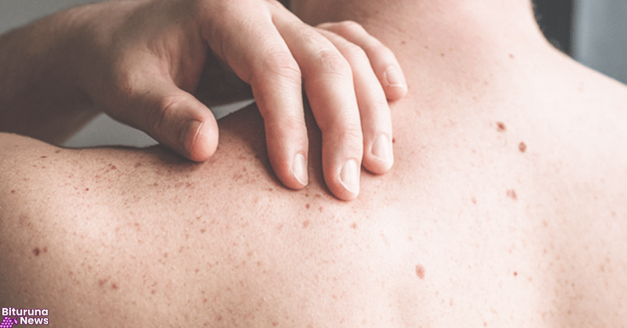 Casos de câncer de pele disparam de 4 mil para mais de 72 mil em uma década no Brasil