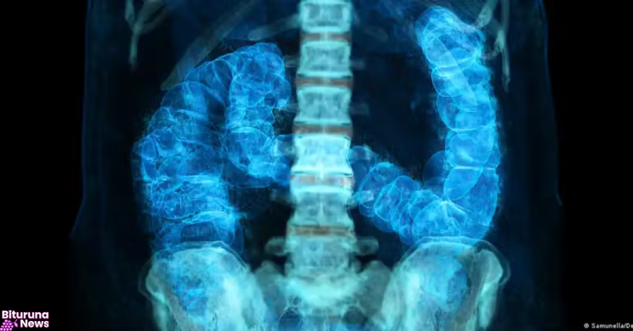 Entenda os fatores de risco do câncer colorretal, que avança entre jovens