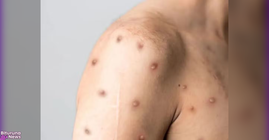 Brasil registra 88 casos de Mpox em 2026; saiba como evitar a doença