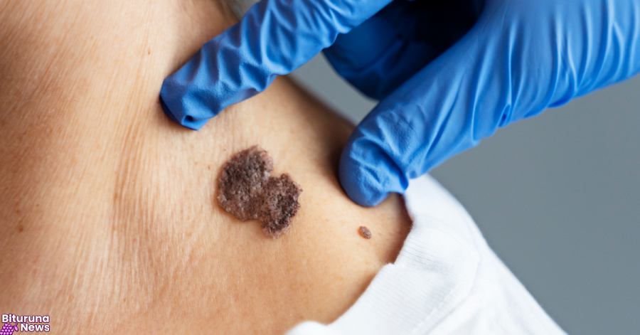 Câncer: estudo alerta para riscos de melanoma fora da pele
